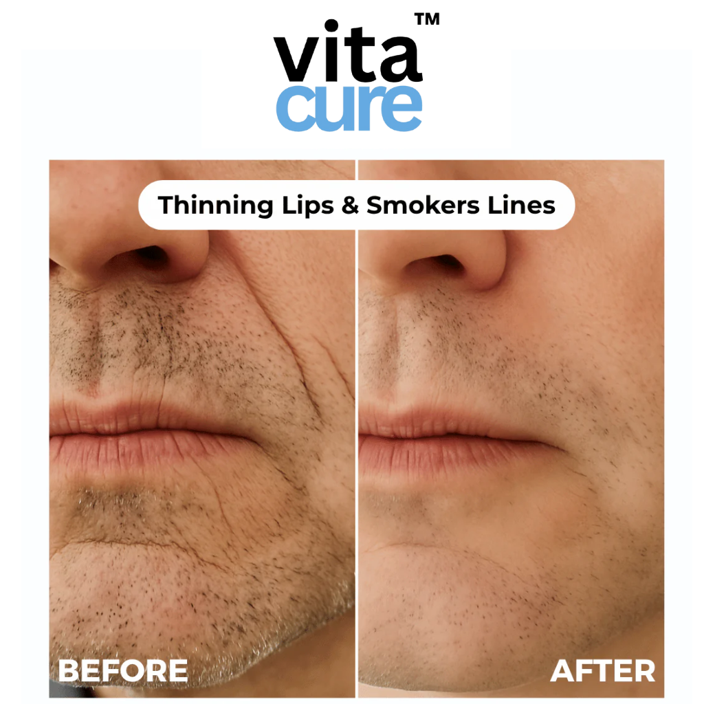Vitacure™  – Anti-Wrinkle Freeze-Dried Nano-Silk Collagen System