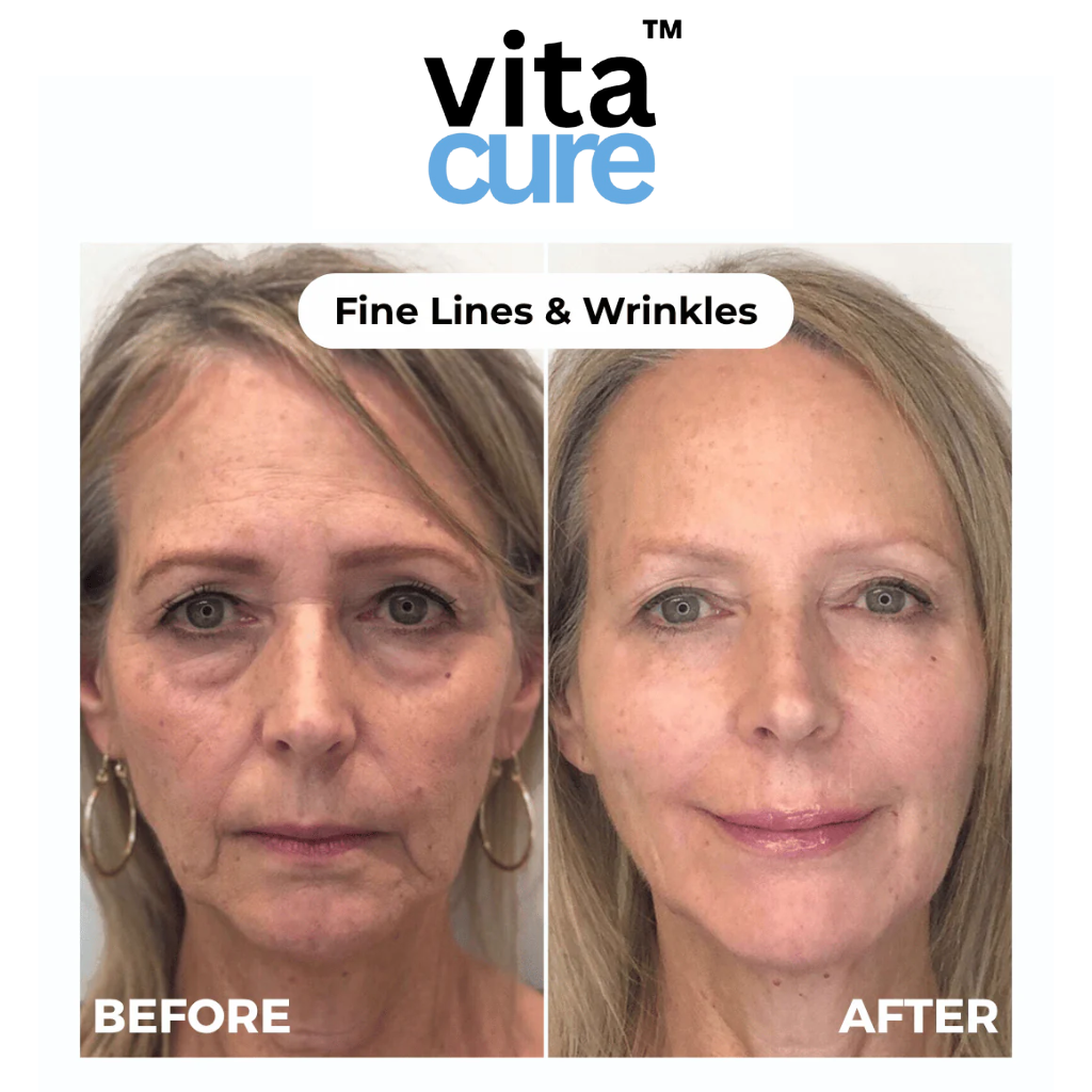 Vitacure™  – Anti-Wrinkle Freeze-Dried Nano-Silk Collagen System