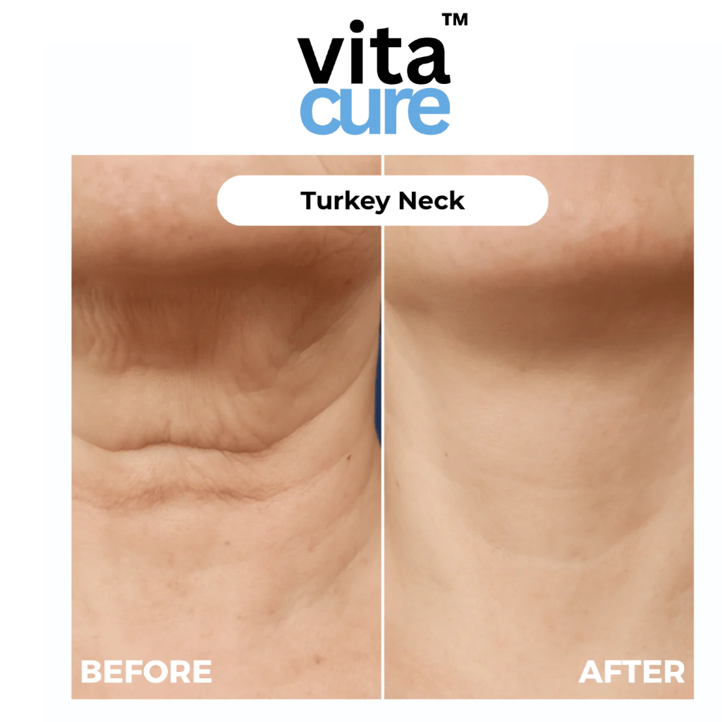 Vitacure™  – Anti-Wrinkle Freeze-Dried Nano-Silk Collagen System